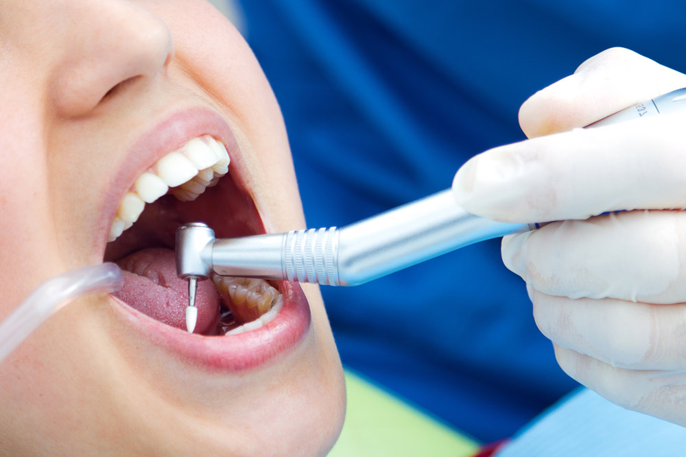 Dental Kompozit Çeşitleri