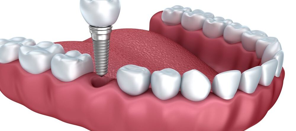 Diş İmplantı