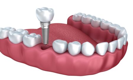 Dental Implant