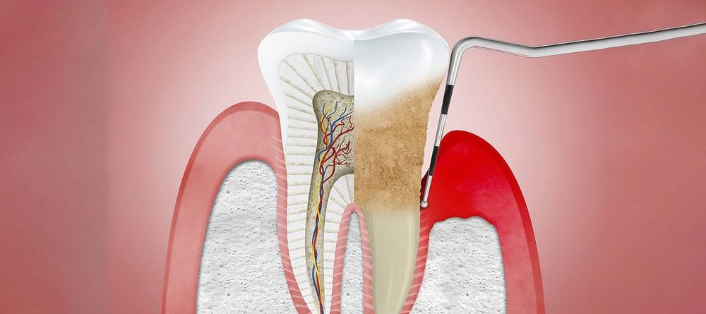 Periodontal Cihazı