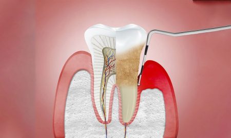 Periodontal Cihazı