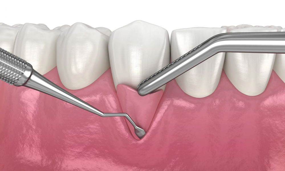 Periodontal Cihazı