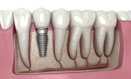 Dental Implant Prices