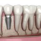 Dental Implant Prices