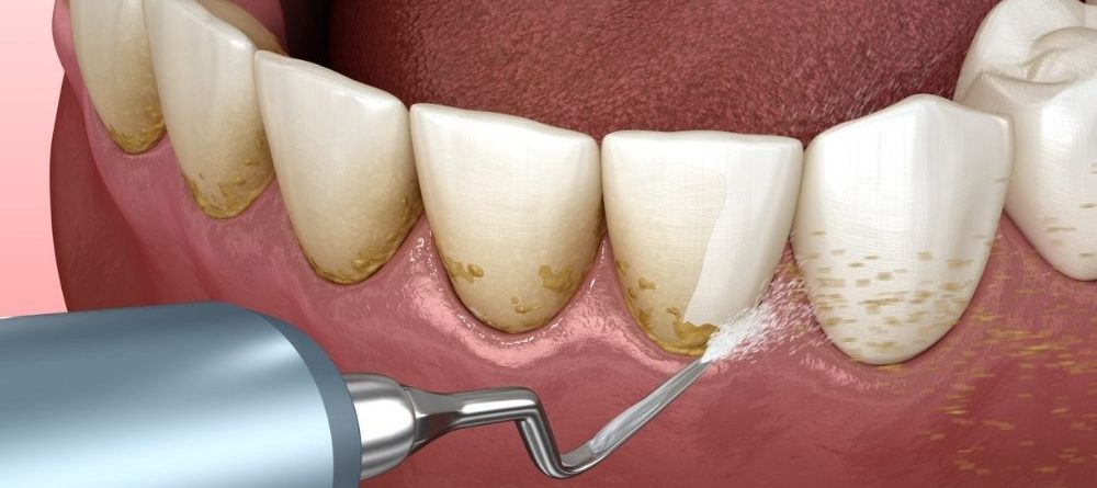 Periodontal Cihazı Nedir