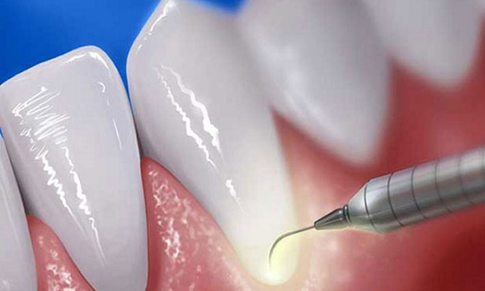 Periodontal Cihazı Nedir