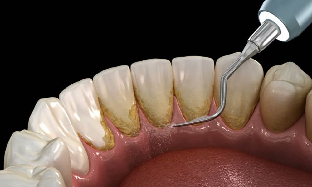 Periodontal Cihazı Nedir