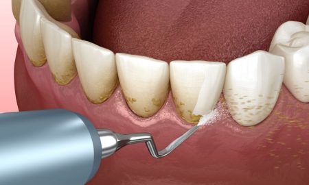 Periodontal Cihazı Nedir