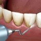 Periodontal Cihazı Nedir